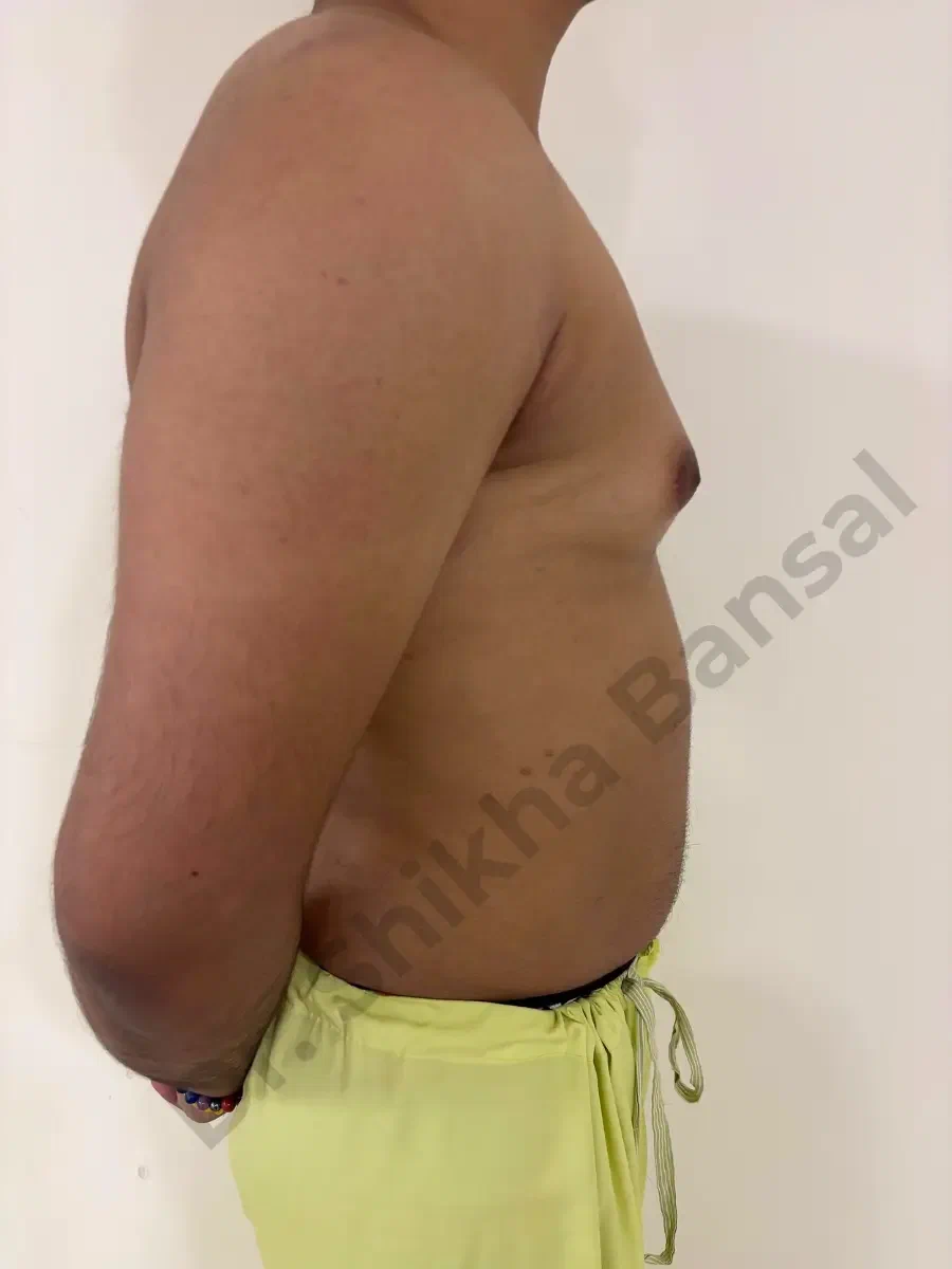 Before - Gynecomastia Surgery