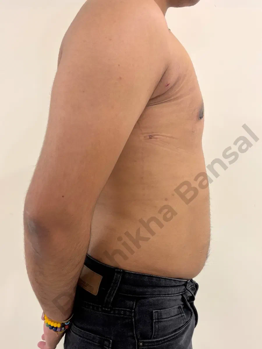 After - Gynecomastia Surgery