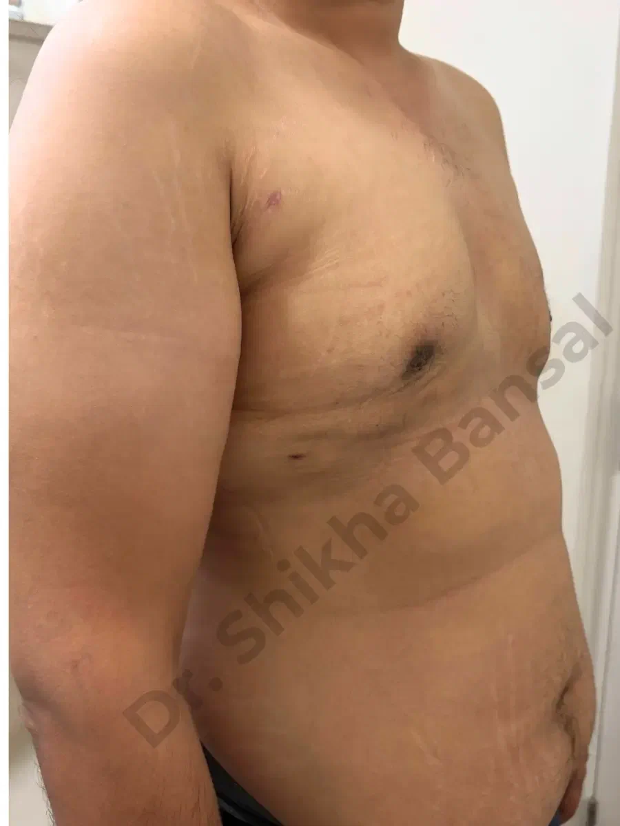 After photo for Gynecomastia Surgery