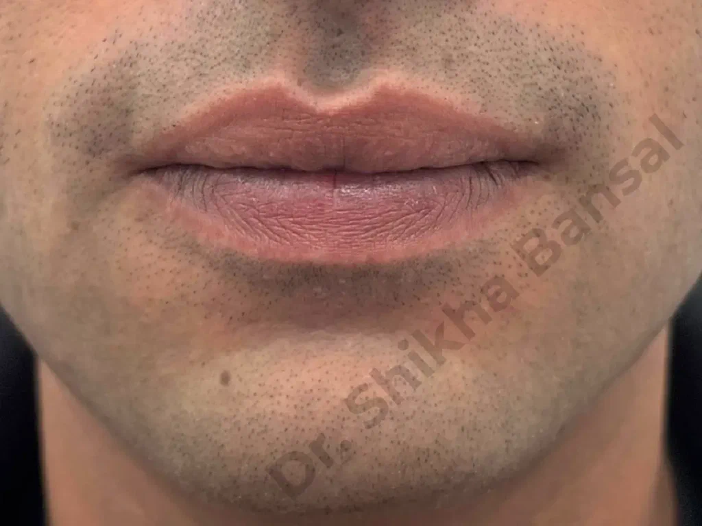 After - Lip Reduction
