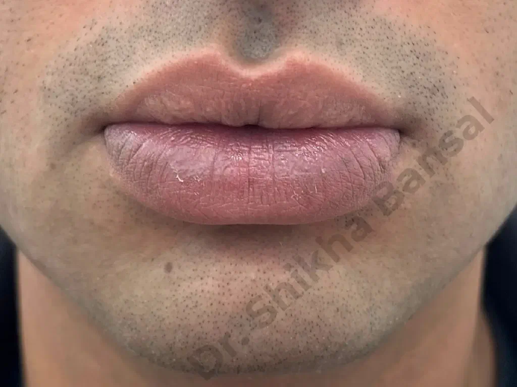 Before photo for Lip Reduction