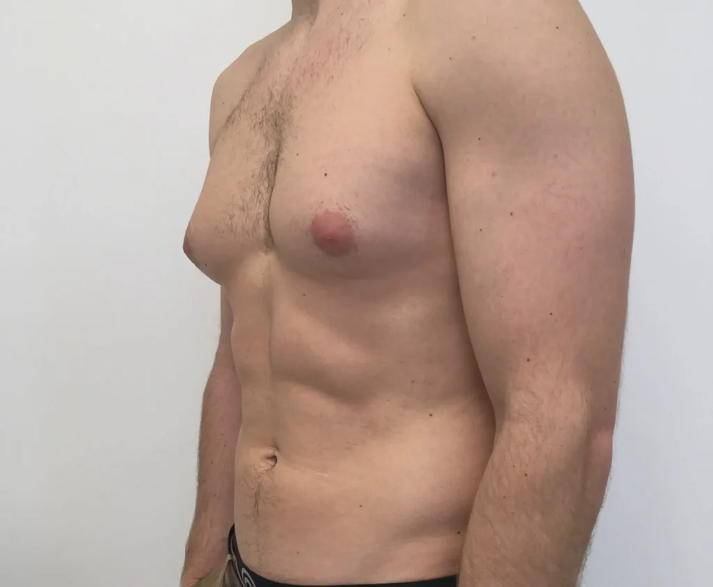 Gynecomastia Procedure