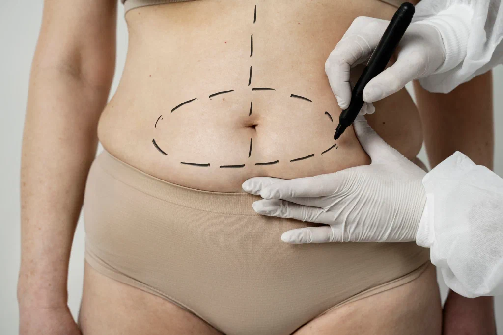Abdominoplasty (Tummy Tuck) Procedure
